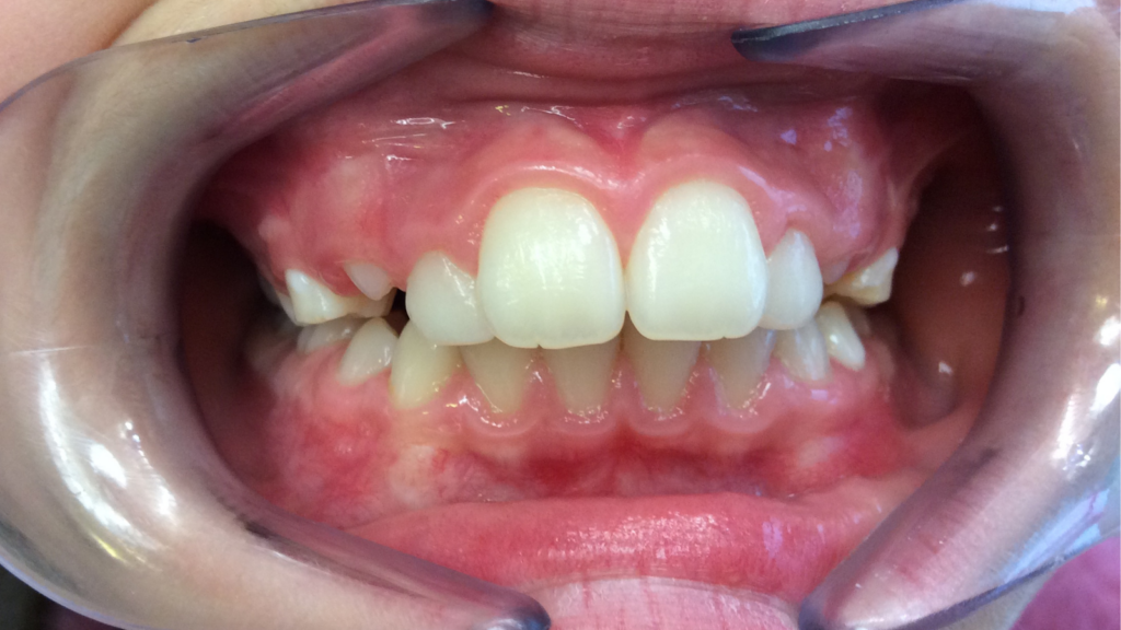 Résultats avant / après pose de bagues orthodontie par le dr Ronchini, orthodontiste à Carbonne au sud de Toulouse.