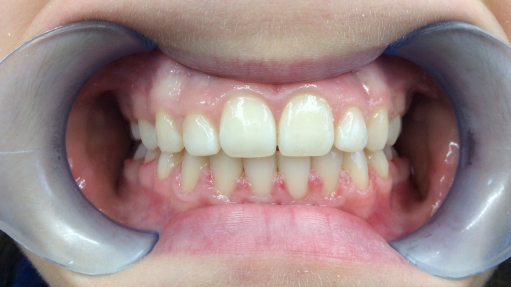 Résultats avant / après pose de bagues orthodontie par le dr Ronchini, orthodontiste à Carbonne au sud de Toulouse.