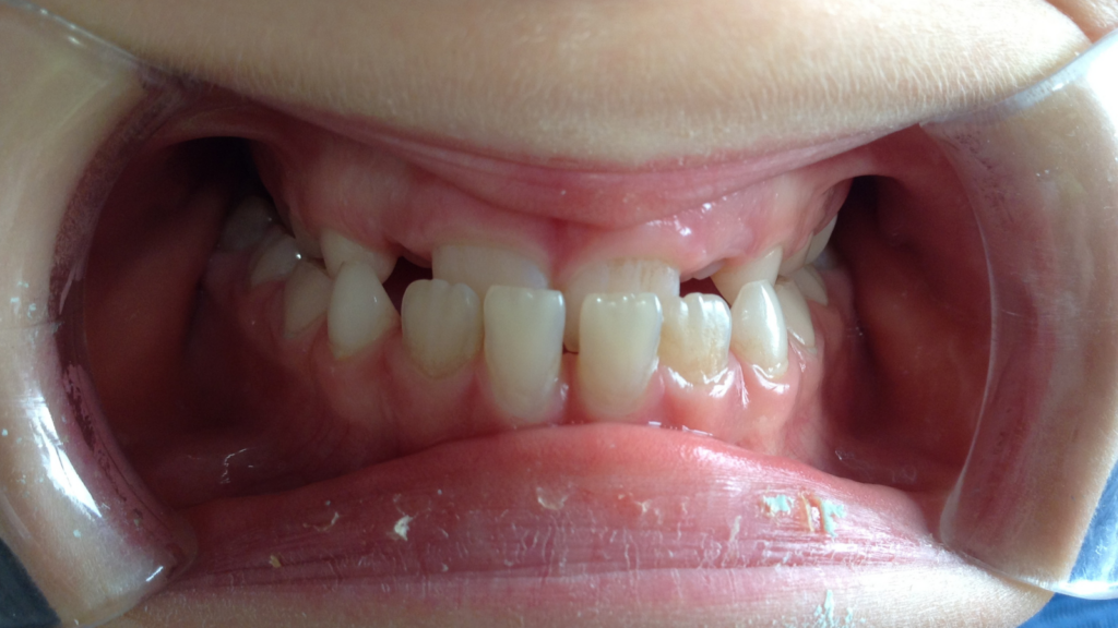 Résultats avant / après pose de bagues orthodontie par le dr Ronchini, orthodontiste à Carbonne au sud de Toulouse.