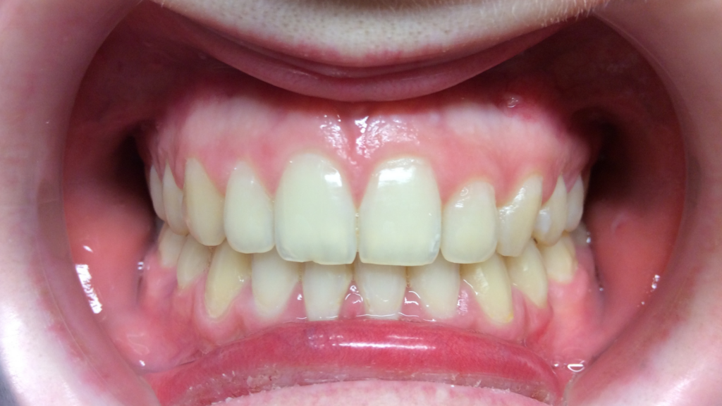 Résultats avant / après pose de bagues orthodontie par le dr Ronchini, orthodontiste à Carbonne au sud de Toulouse.