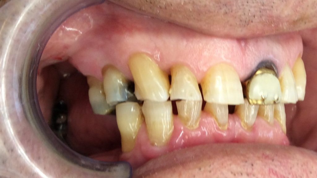 Avant / Après Pose d'une prothèse dentaire par le Dr Ronchini, dentiste sur Carbonne au sud de Toulouse spécialisée dans la parodontie (méthode Bonner), l'implantologie et l'orthodontie.