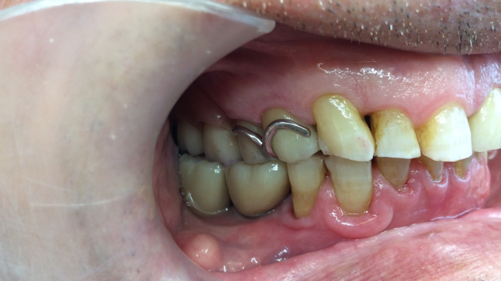Avant / Après Pose d'une prothèse dentaire par le Dr Ronchini, dentiste sur Carbonne au sud de Toulouse spécialisée dans la parodontie (méthode Bonner), l'implantologie et l'orthodontie.