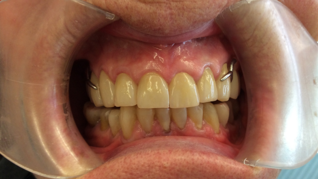Avant / Après Pose d'une prothèse dentaire par le Dr Ronchini, dentiste sur Carbonne au sud de Toulouse spécialisée dans la parodontie (méthode Bonner), l'implantologie et l'orthodontie.