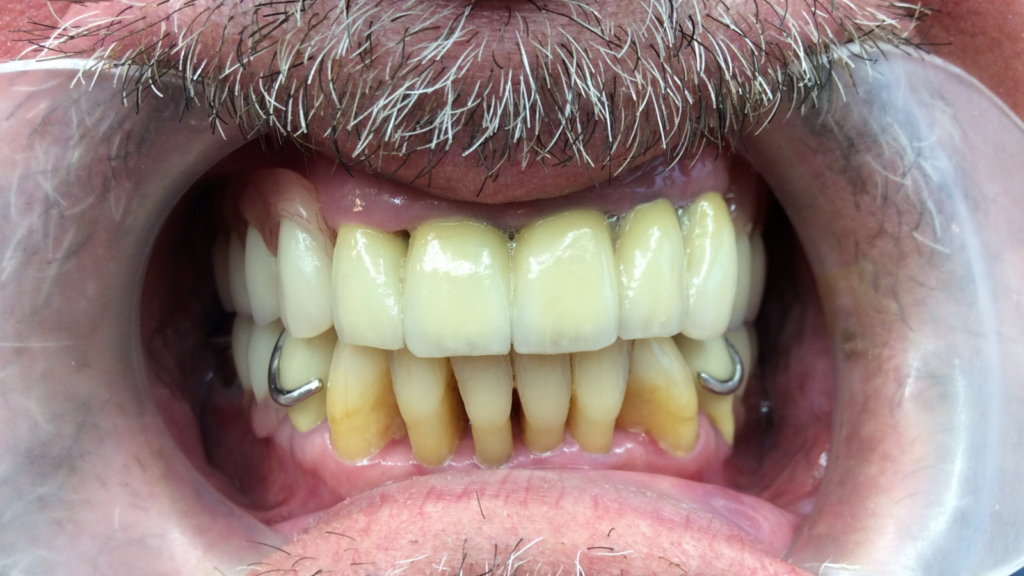 Avant apres pose d'implant dentaire par le cabinet dentaire du dr Ronchini, dentiste à carbonne