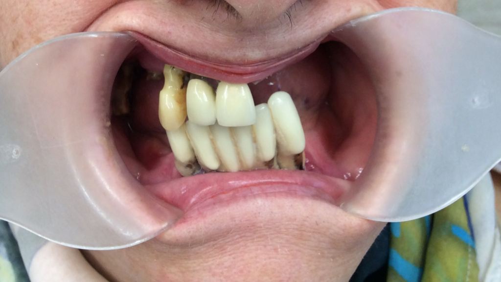 Avant / Après Pose d'une prothèse dentaire par le Dr Ronchini, dentiste sur Carbonne au sud de Toulouse spécialisée dans la parodontie (méthode Bonner), l'implantologie et l'orthodontie.