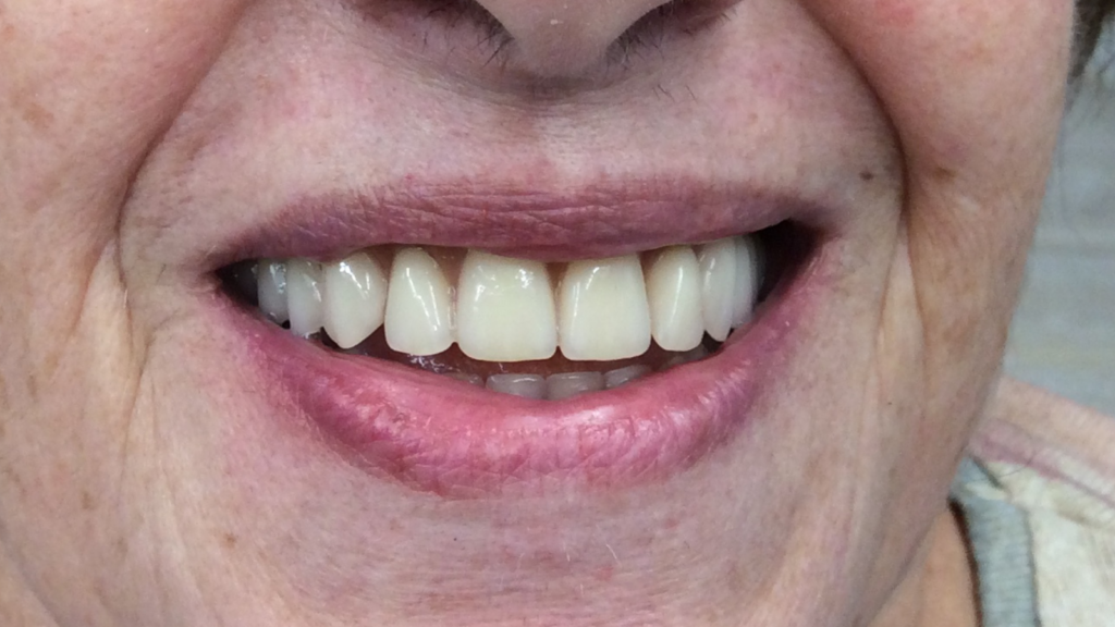 Avant / Après Pose d'une prothèse dentaire par le Dr Ronchini, dentiste sur Carbonne au sud de Toulouse spécialisée dans la parodontie (méthode Bonner), l'implantologie et l'orthodontie.
