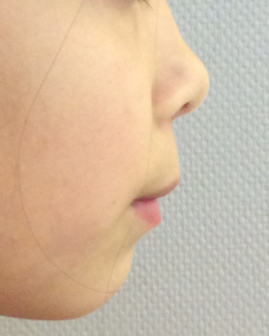 Résultats avant / après pose de bagues orthodontie par le dr Ronchini, orthodontiste à Carbonne au sud de Toulouse.