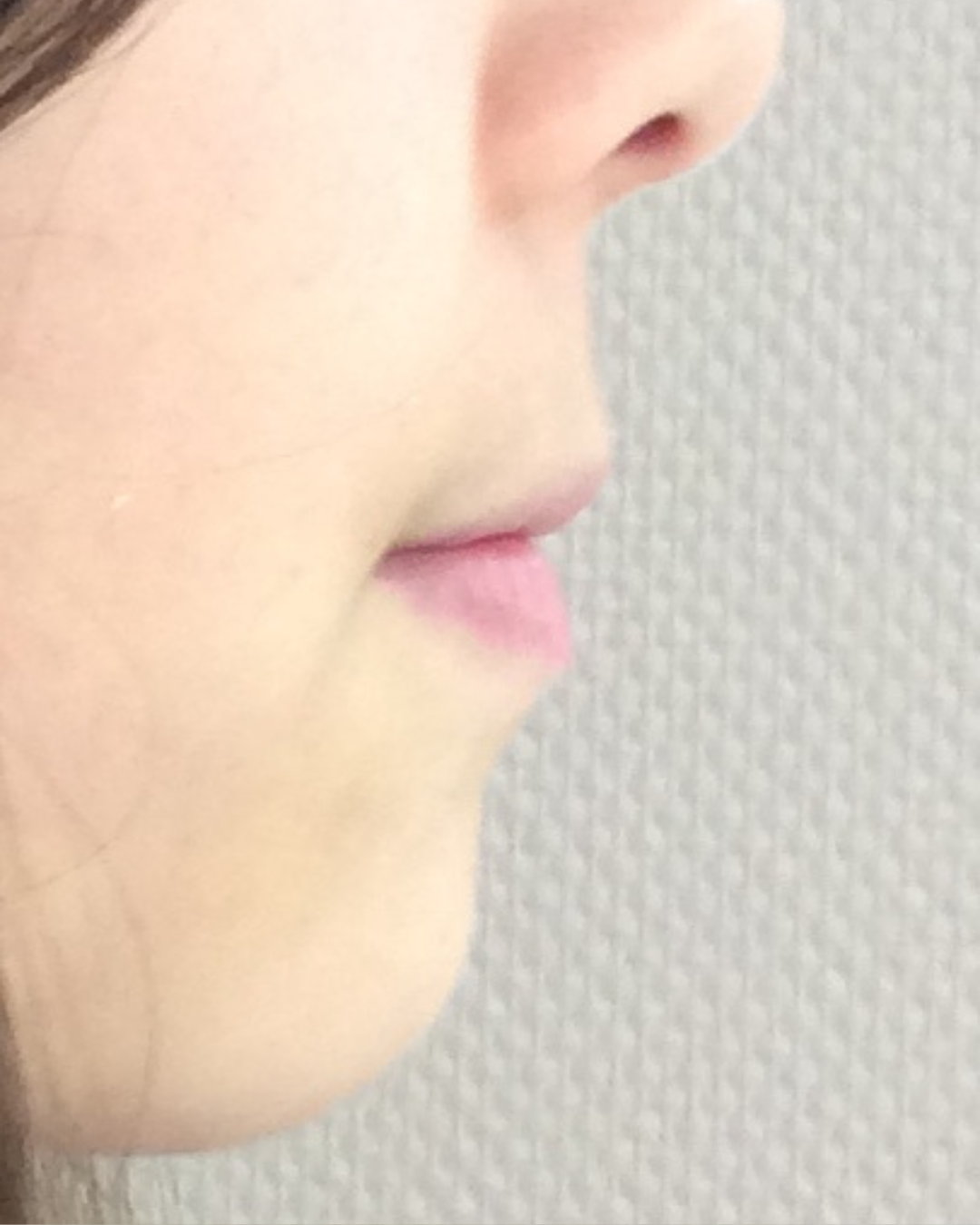 Résultats avant / après pose de bagues orthodontie par le dr Ronchini, orthodontiste à Carbonne au sud de Toulouse.