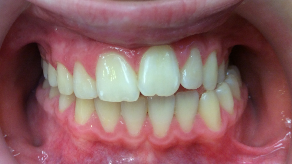 Résultats avant / après pose de bagues orthodontie par le dr Ronchini, orthodontiste à Carbonne au sud de Toulouse.