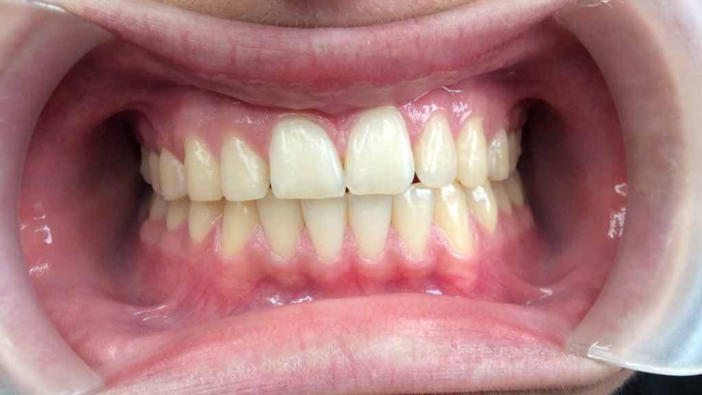 Résultats avant / après pose de bagues orthodontie par le dr Ronchini, orthodontiste à Carbonne au sud de Toulouse.