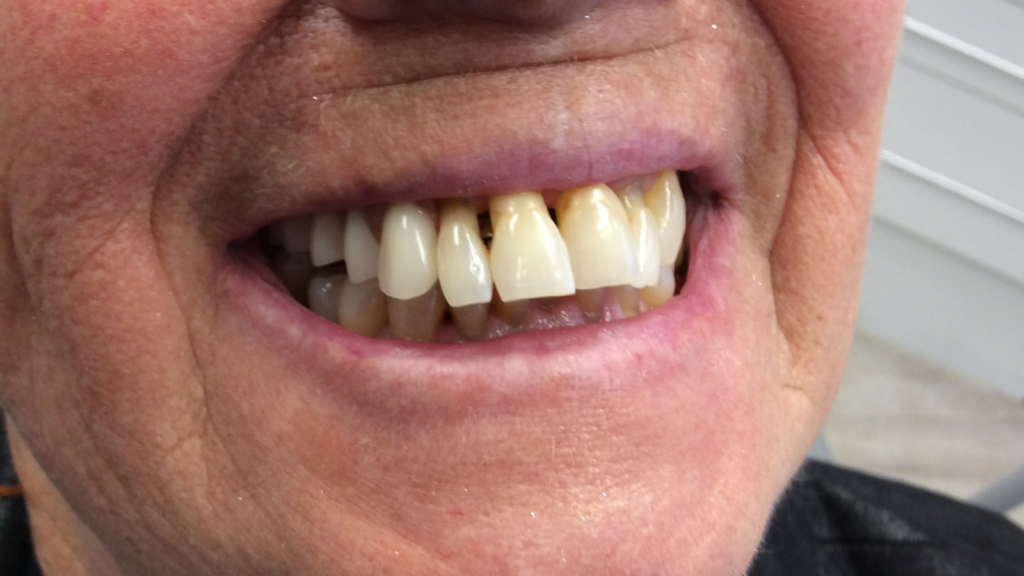 Avant apres pose d'implant dentaire par le cabinet dentaire du dr Ronchini, dentiste à carbonne