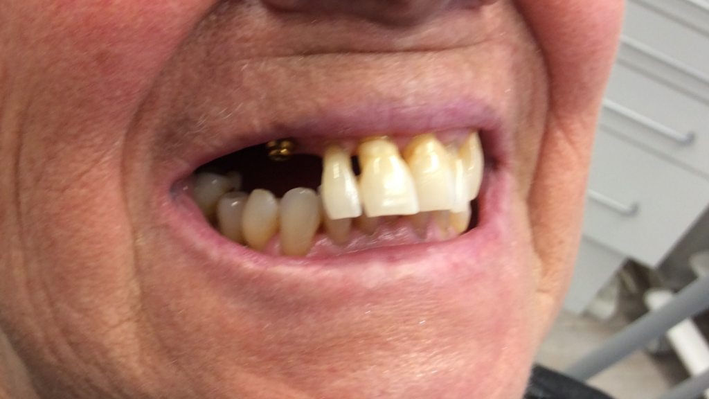 Avant apres pose d'implant dentaire par le cabinet dentaire du dr Ronchini, dentiste à carbonne