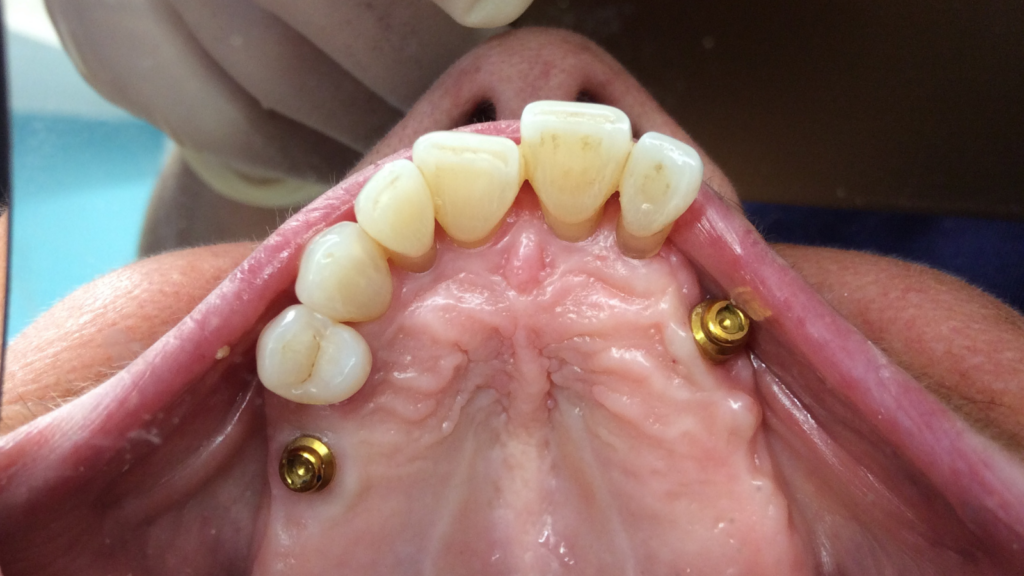 Avant apres pose d'implant dentaire par le cabinet dentaire du dr Ronchini, dentiste à carbonne