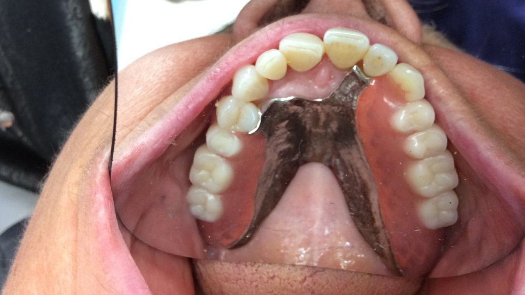 Avant apres pose d'implant dentaire par le cabinet dentaire du dr Ronchini, dentiste à carbonne