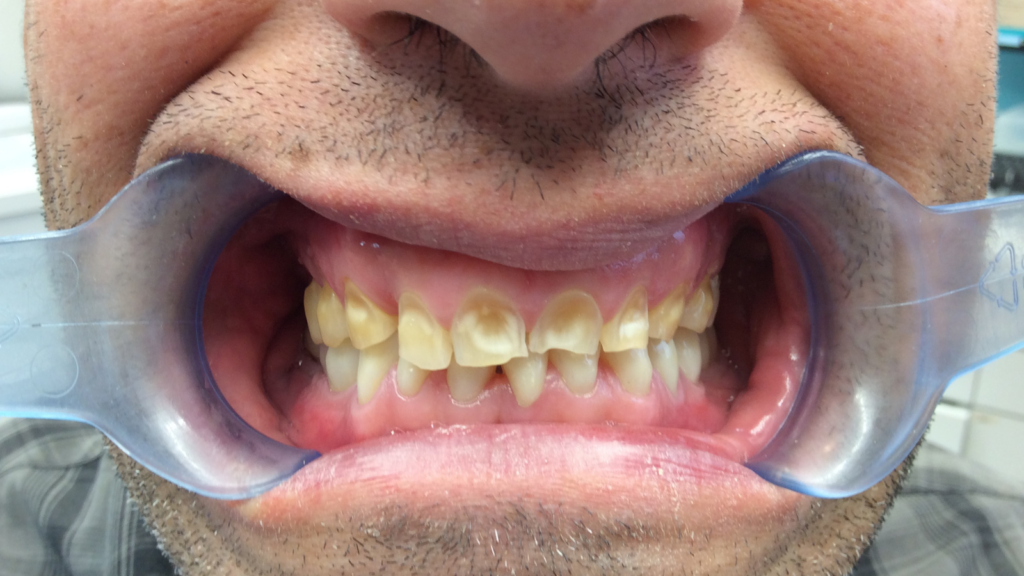 Avant / Après Pose d'une prothèse dentaire par le Dr Ronchini, dentiste sur Carbonne au sud de Toulouse spécialisée dans la parodontie (méthode Bonner), l'implantologie et l'orthodontie.