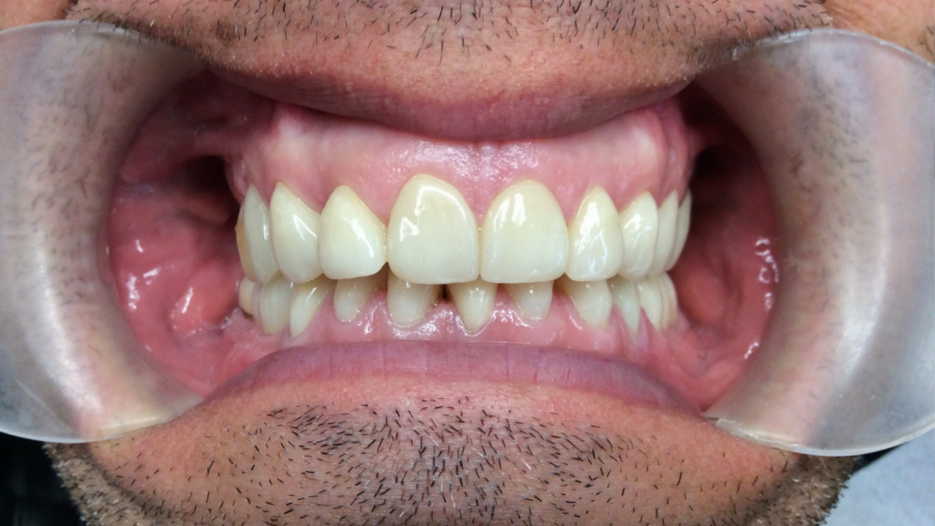 Avant / Après Pose d'une prothèse dentaire par le Dr Ronchini, dentiste sur Carbonne au sud de Toulouse spécialisée dans la parodontie (méthode Bonner), l'implantologie et l'orthodontie.