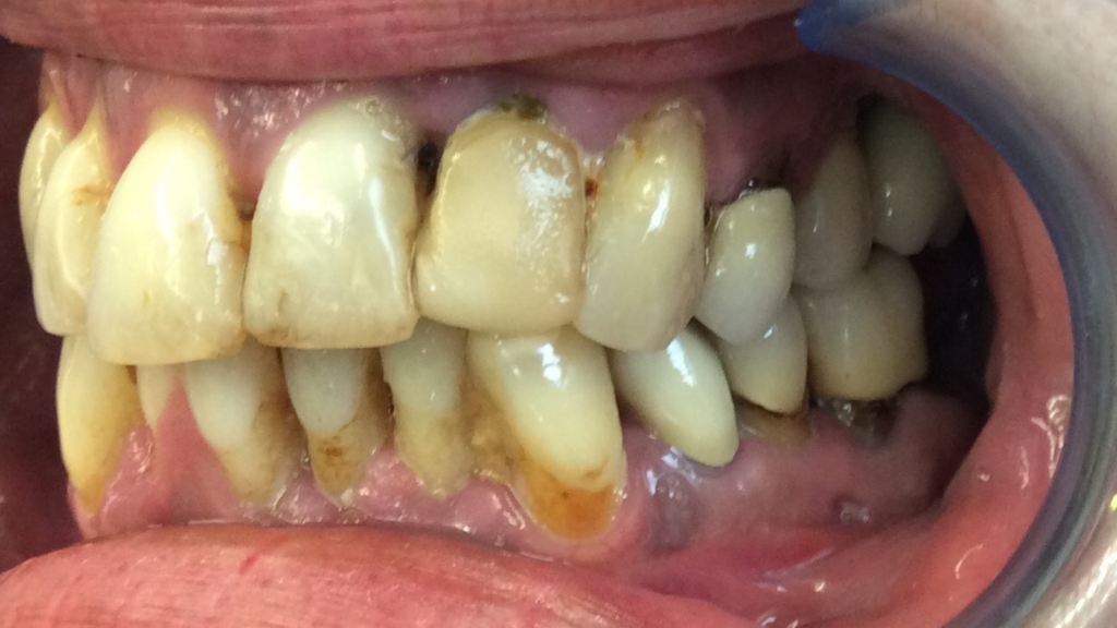 Avant / Après soin en parodontie par le Dr Ronchini Catherine, chirurgien dentiste sur Carbonne au sud Toulouse, Spécialisée dans la parodontie et la Méthode Bonner.