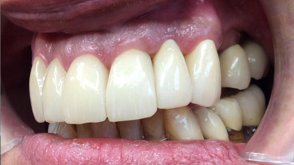 Avant / Après soin en parodontie par le Dr Ronchini Catherine, chirurgien dentiste sur Carbonne au sud Toulouse, Spécialisée dans la parodontie et la Méthode Bonner.
