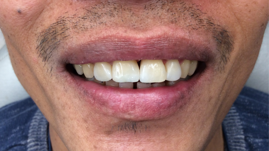 Avant / Après Pose d'une prothèse dentaire par le Dr Ronchini, dentiste sur Carbonne au sud de Toulouse spécialisée dans la parodontie (méthode Bonner), l'implantologie et l'orthodontie.