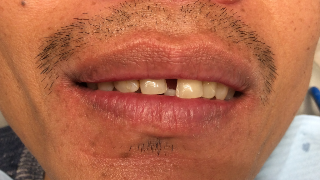 Avant / Après Pose d'une prothèse dentaire par le Dr Ronchini, dentiste sur Carbonne au sud de Toulouse spécialisée dans la parodontie (méthode Bonner), l'implantologie et l'orthodontie.