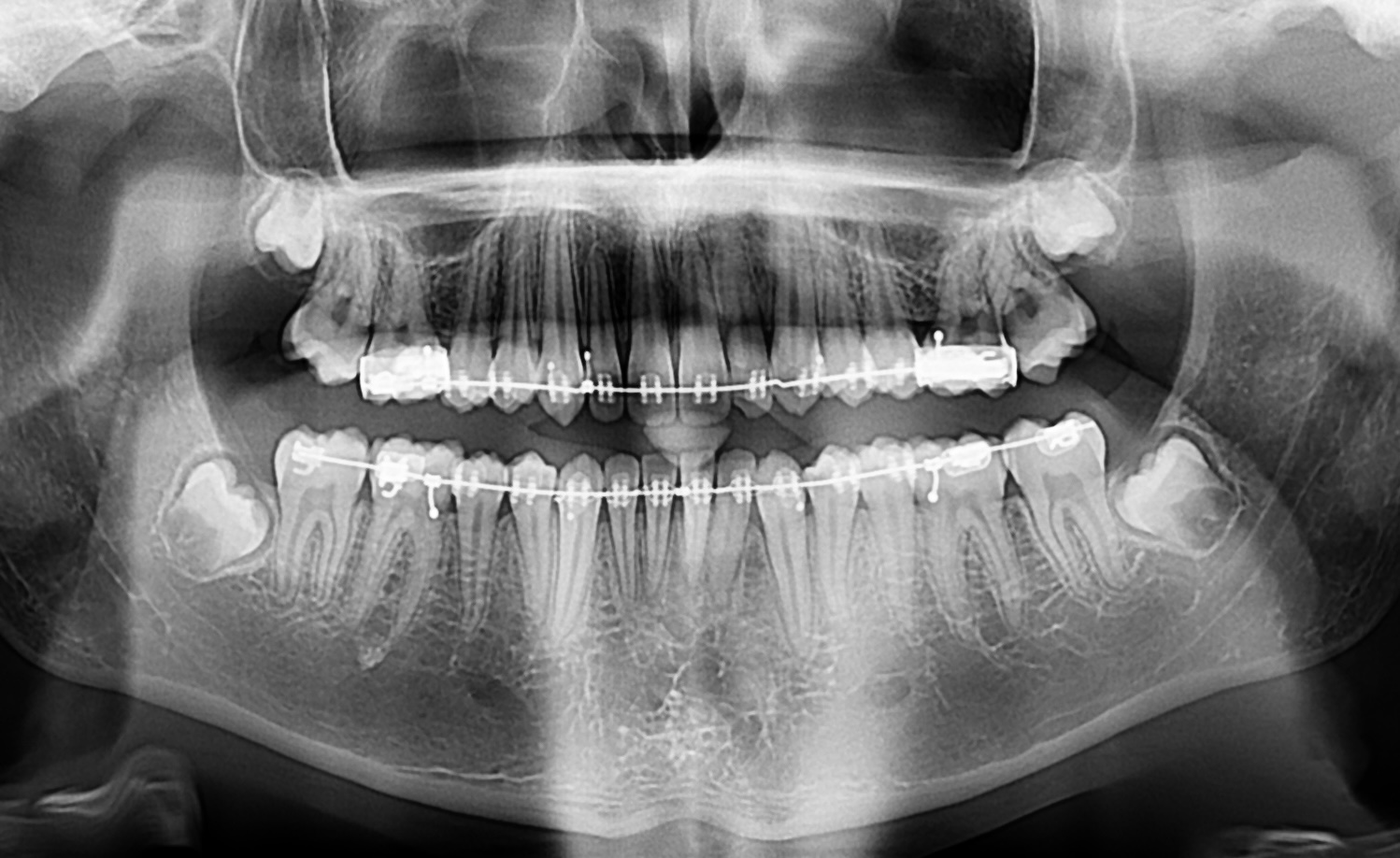 Radio après pose d'un appareil d'orthodontie au cabinet du Dr Ronchini, orthodontiste à Carbonne, au sud de Toulouse.