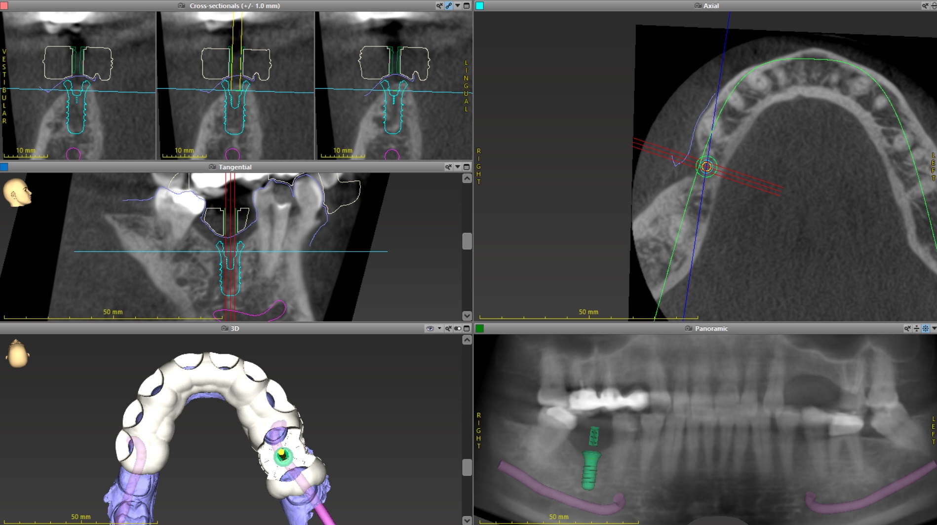 Radio d'un implant dentaire par le Dr Ronchini Catherine, chirurgien de ntiste sur Carbonne.