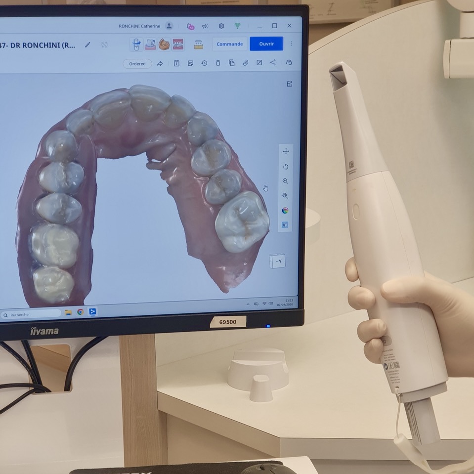 Pose d'une prothèse dentaire par le Dr Ronchini, dentiste sur Carbonne au sud de Toulouse spécialisée dans la parodontie (méthode Bonner), l'implantologie et l'orthodontie.