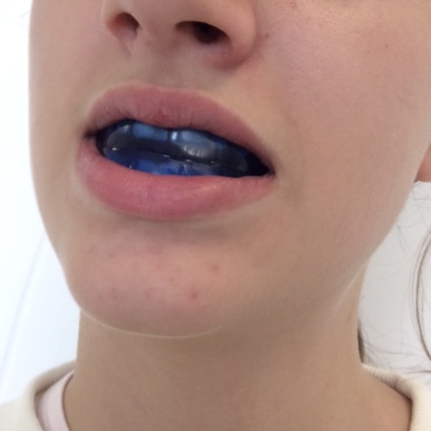 Pose d'un appareil fonctionnels pour les enfants, orthodontie, sur Carbonne.